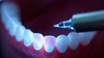 В России начались испытания зонда для точного обнаружения кариеса.